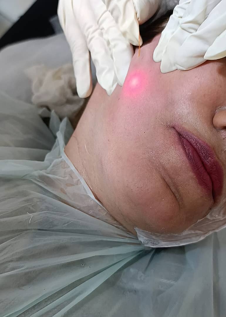 انجام اندولیفت