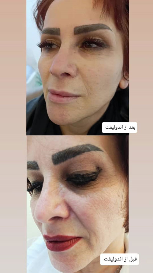 اندولیفت رودهن دکتر پورجم