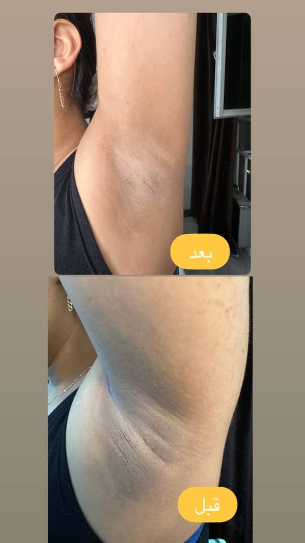 روشن سازی بدن با دستگاه کیو سوییچ