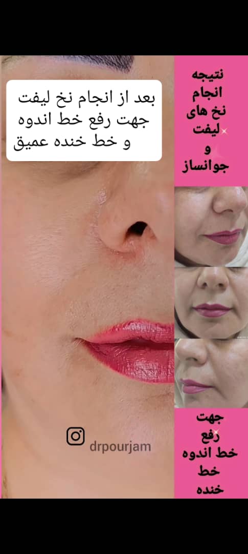 نخ جوانسازی دکتر پورجم