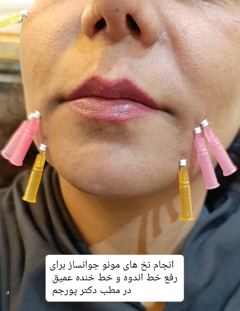 نخ جوانسازی