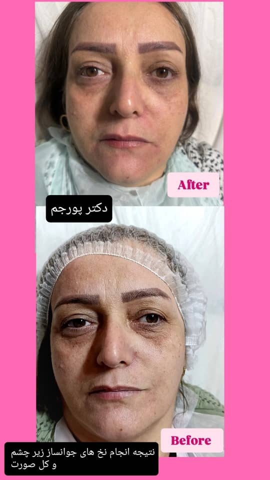 نخ جوانسازی