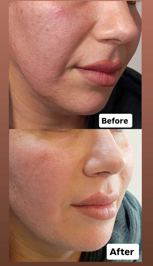 اندولیفت دکتر پورجم