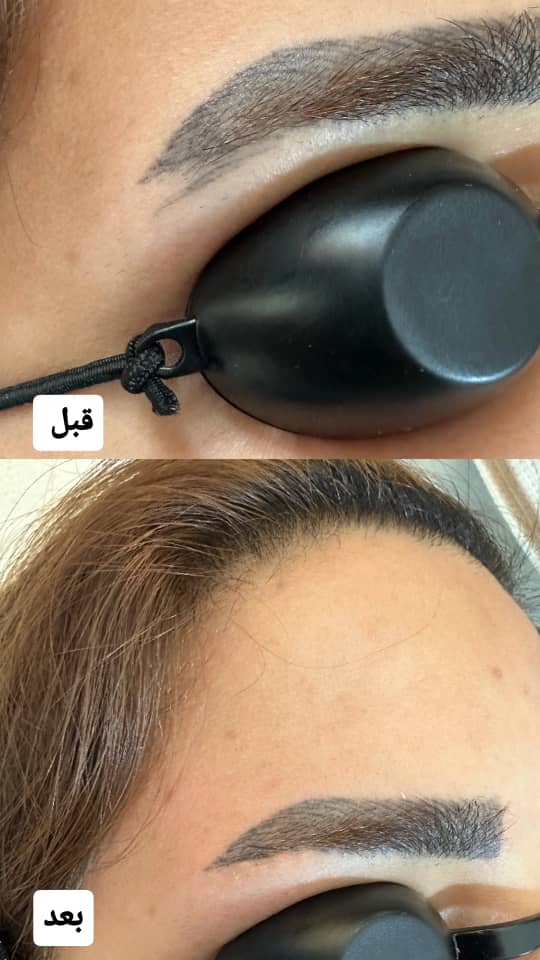 پاک کردن تتو