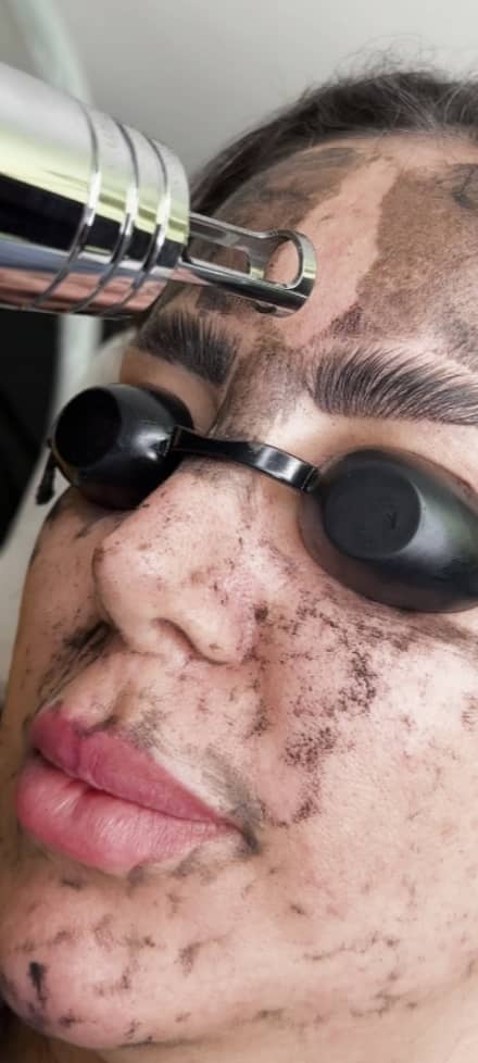 کربوکسی تراپی با دستگاه کیو سوییچ