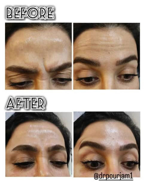 بوتاکس در رودهن