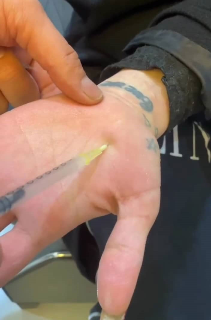 بوتاکس کف دست برای کاهش تعریق 