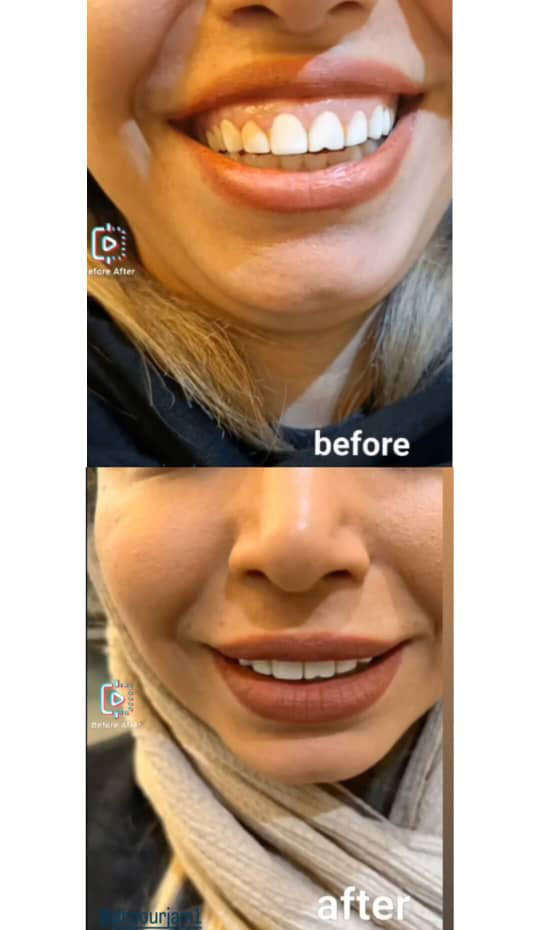 تزریق بوتاکس در رودهن دکتر پورجم