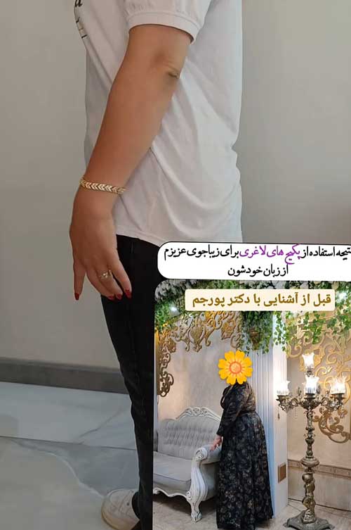 لاغری موضعی در بومهن دکتر پورجم