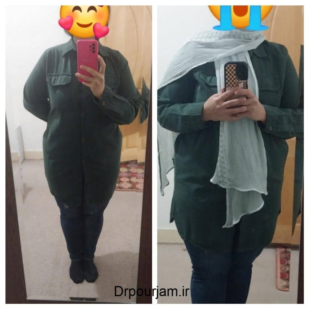 لاغری موضعی در رودهن دکتر پورجم